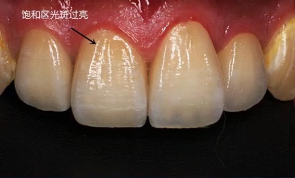 优势:牙本质是受到结构颜色影响最小的区域,而临床比色中,比色板对应