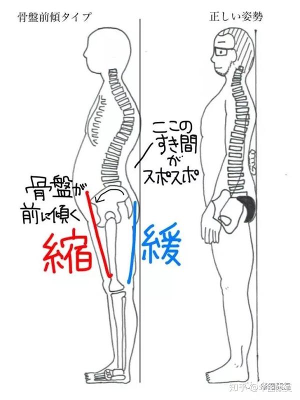 简单来说,骨盆前倾最常出现腰部紧张,疼痛.