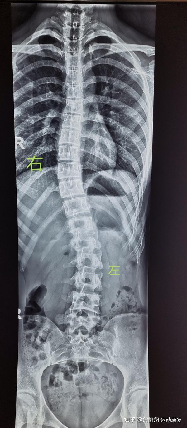 也是要根据不同的情况进行调整的,所以先要去医院拍一个全脊柱x光片