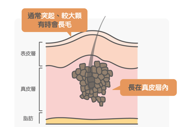 复合痣