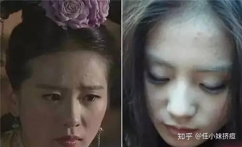 没有经过修图的诗诗姐却是这样的,也是难逃闭口痘痘的"祸害".