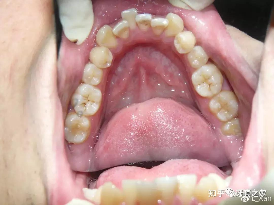 正畸分享 | 瘦下来 整完牙后,感觉人生准备开挂一样