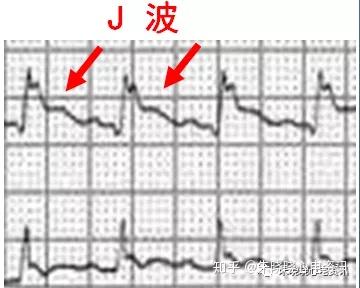刘启明教授:心电图危急值(1)— 急性心梗及特殊图形识别