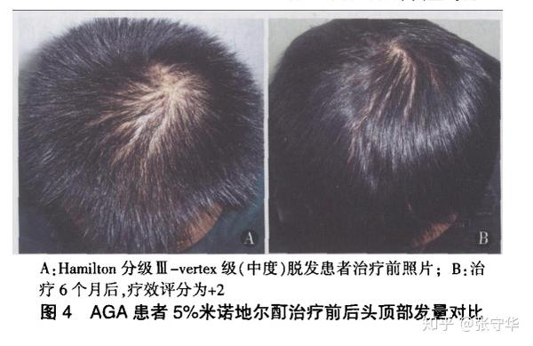 三级脱发患者,治疗6个月后的效果对比