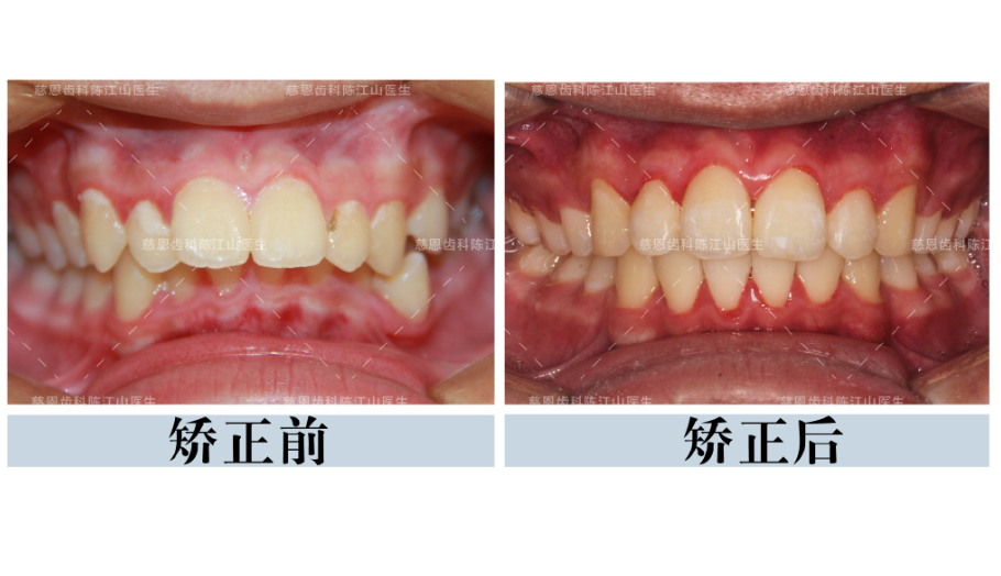 深覆合覆盖矫正:不打骨钉,不需平导