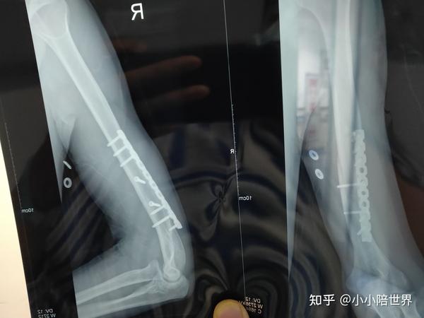 右臂肱骨粉碎性骨折到取钢板手术分享
