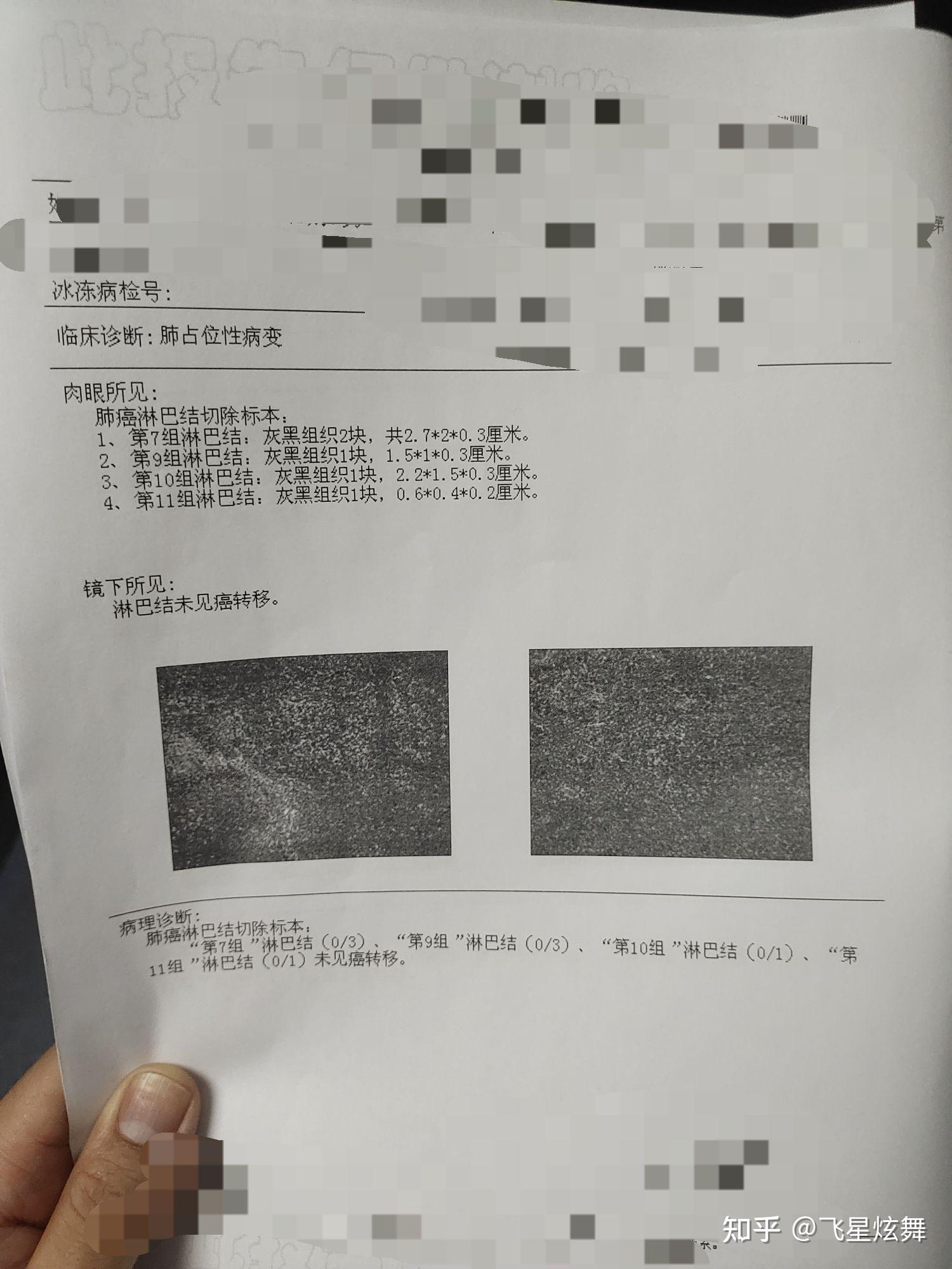 爸爸确诊肺癌以后的坎坷路