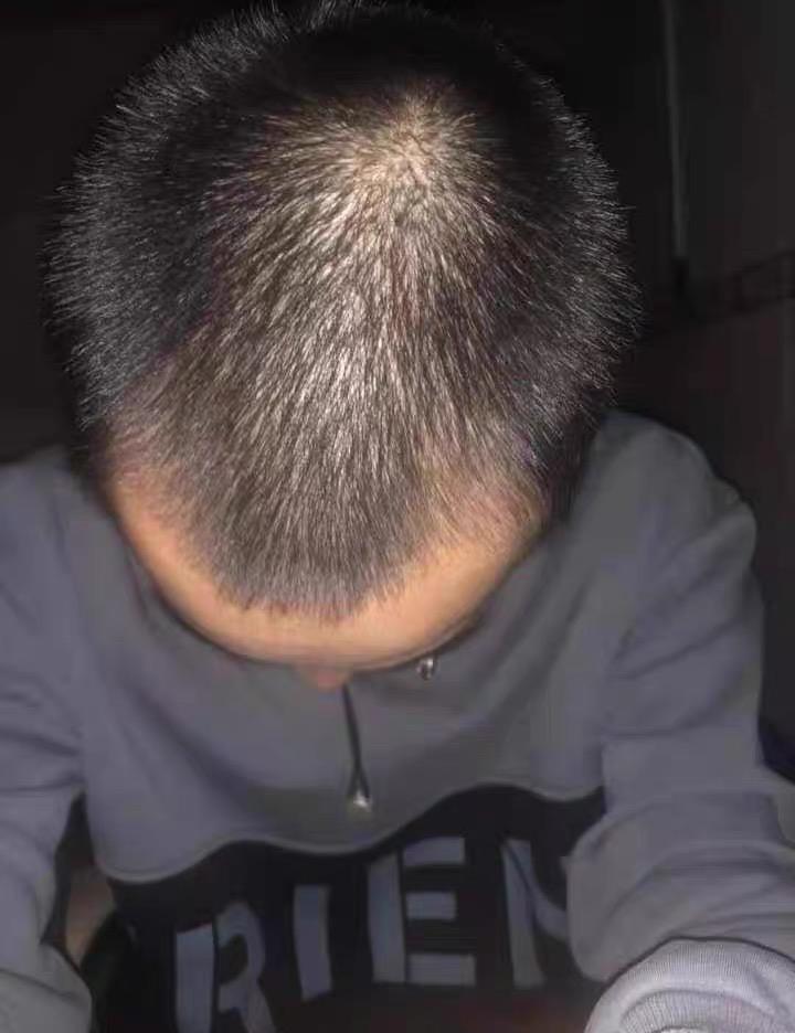 我这2年工作的原因经常熬夜,头发变的非常稀疏,熬夜会导致脱发吗,能有