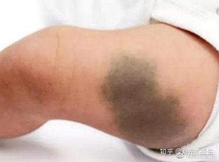 科普| 宝宝身上的青胎记是太田痣吗?如何识别?
