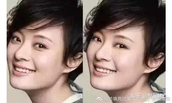 说说卧蚕眼的那点儿事儿