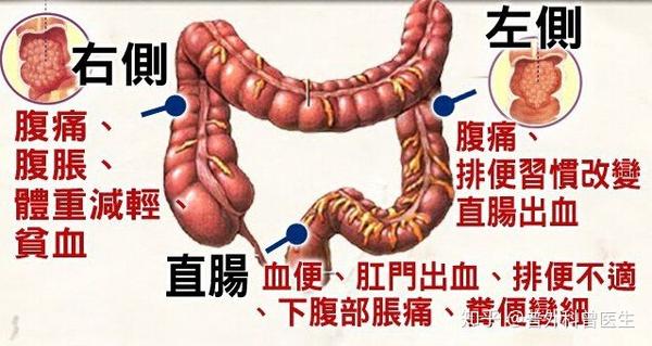 大便突然变细了是一种危险信号小心大肠癌