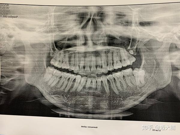 智慧牙长成这样医生说拔牙有风险