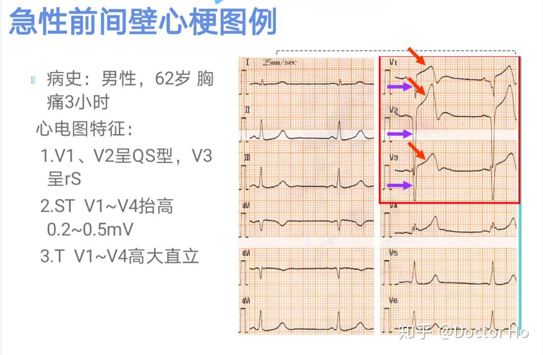 schemic ):是指冠状动脉的供血不能满足心肌代谢需要