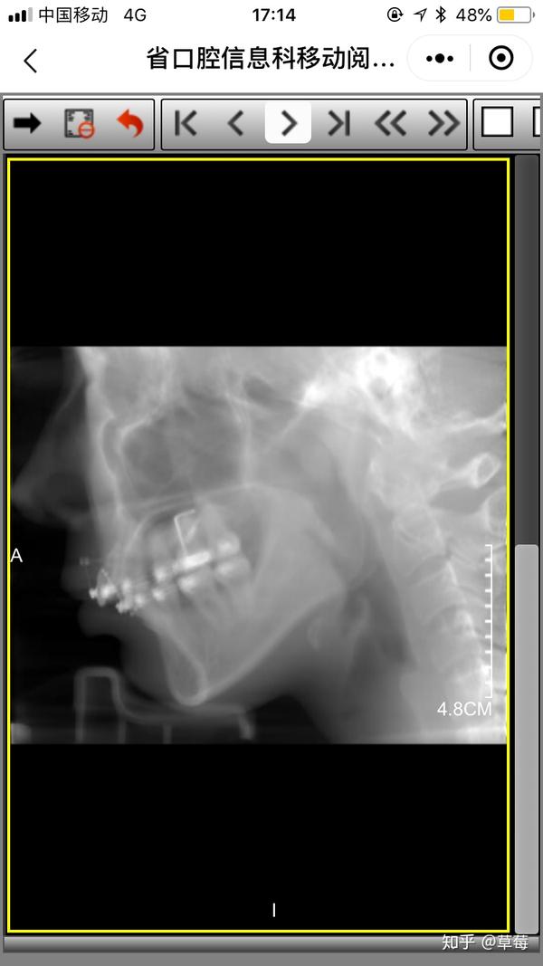 正畸内收一半出现牙周严重萎缩和骨开窗怎么办