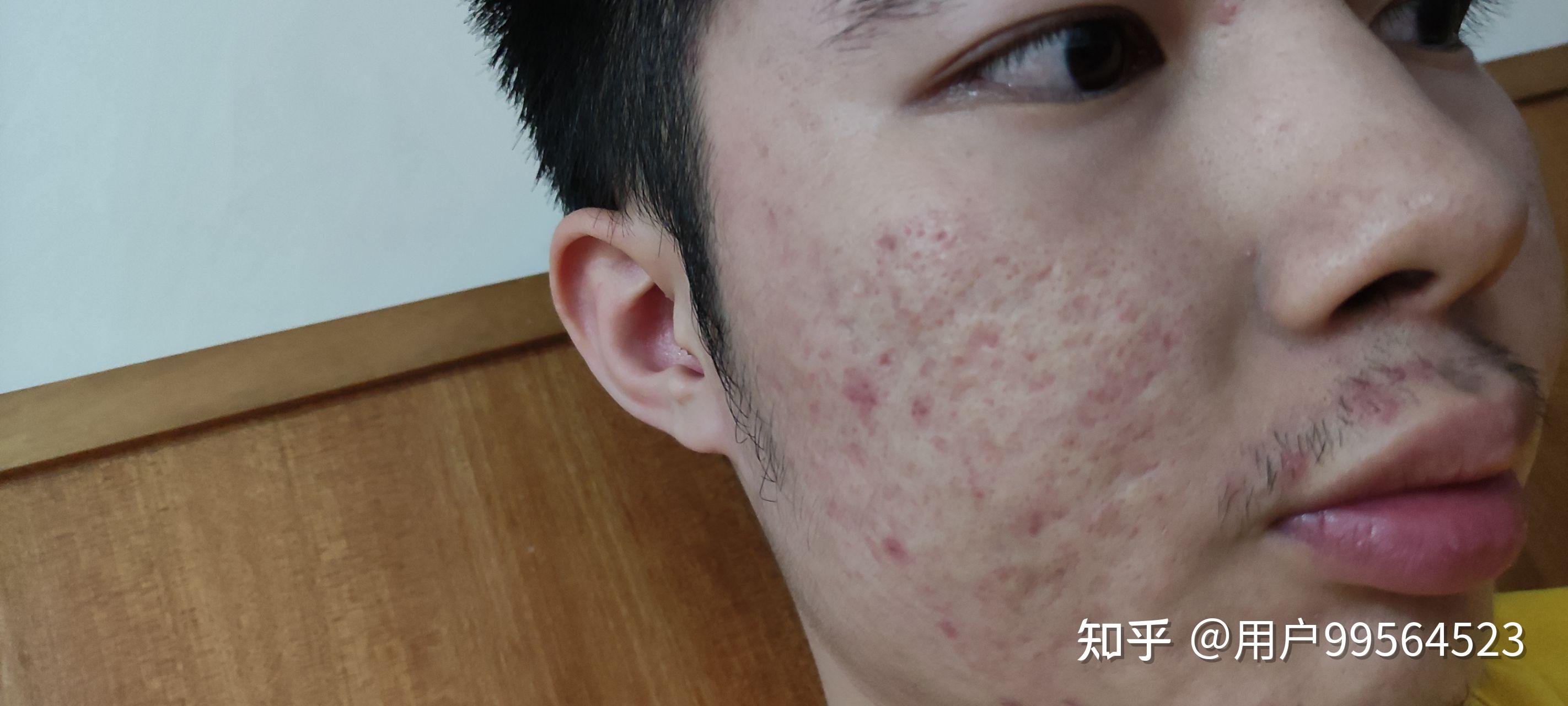 点阵激光效果明显吗