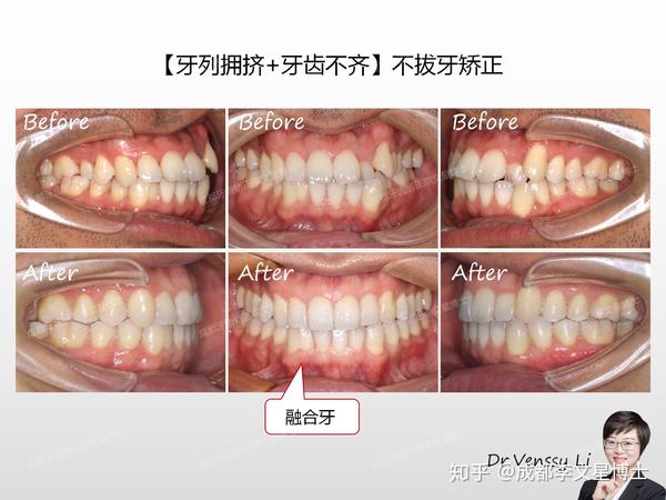 正畸前后口内照对比