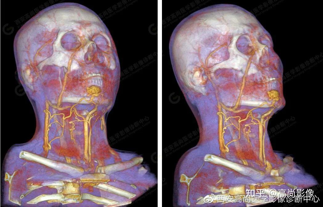 西安高尚病例颌面部血管畸形ctactv成像技术应用