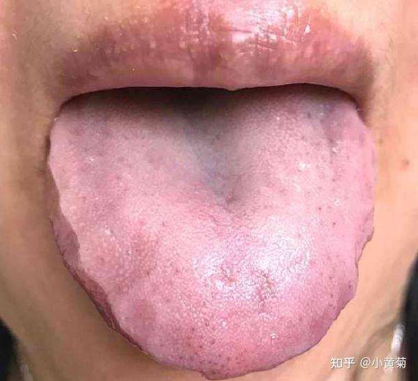 看舌头舌象分析与疾病一