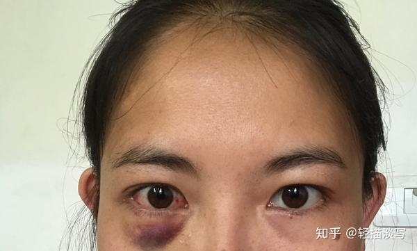 记录斜视手术的一天n