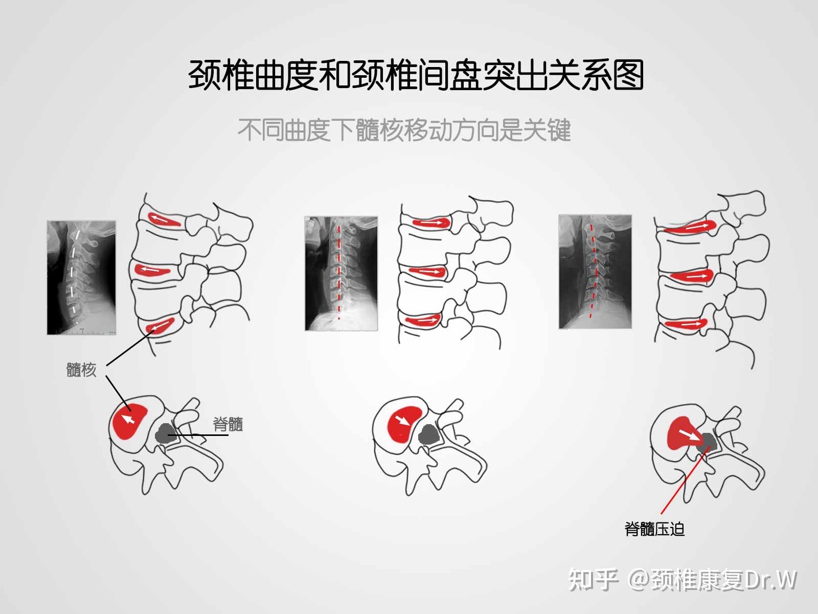 什么按摩枕适合颈椎反弓人群使用更安全 知乎