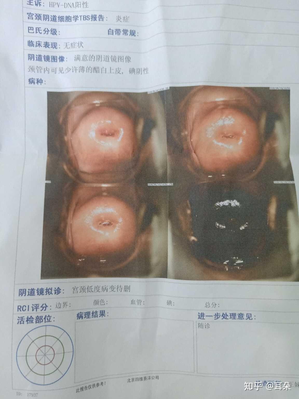 hpv39型高危,细菌性阴道炎,霉菌性阴道炎,外阴炎都治好了!