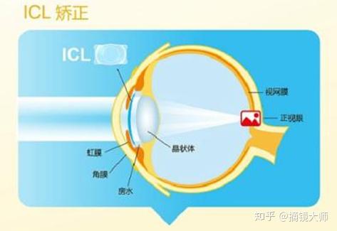 近视手术必看icl晶体植入术超强科普