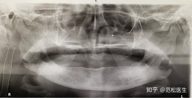 放射性龋齿 由于牙齿在口腔中的分布范围较广,因此在头颈部肿瘤放疗中