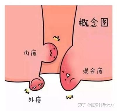 痔疮术后疼痛怎么办?怎么防止复发?