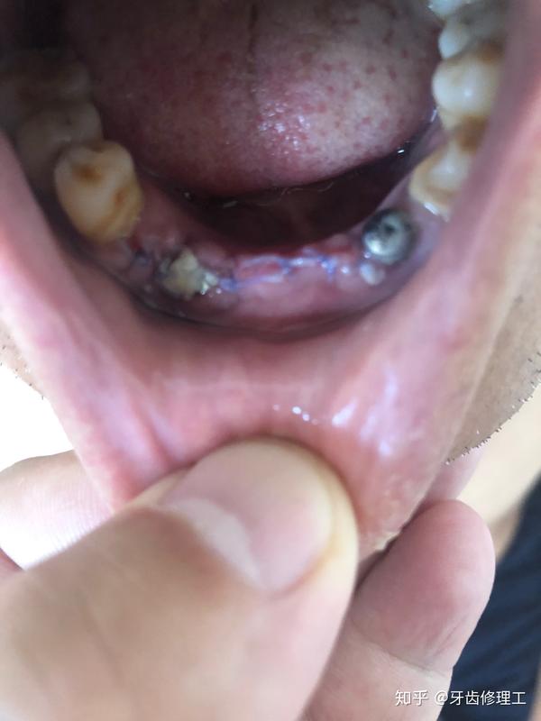记录每一例种植牙手术,2019.7.15 下午