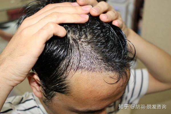 熬夜导致m型脱发,经过改善,终于彻底告别了脱发