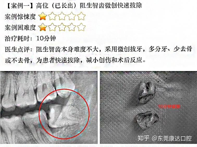 牙根的数量,是否弯曲说起几乎人人惧怕的拔阻生智齿图片,其复杂困难