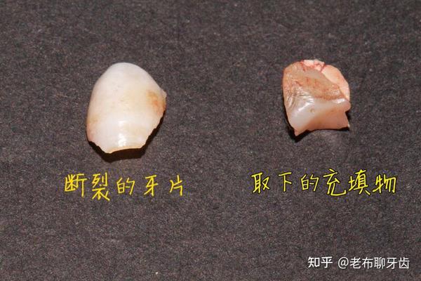 可见…根管治疗后做牙套保护是多麼重要的事情!