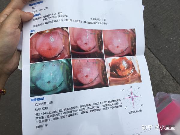 hpv16高度病变感染快一年,现在终于转阴了,记录一下