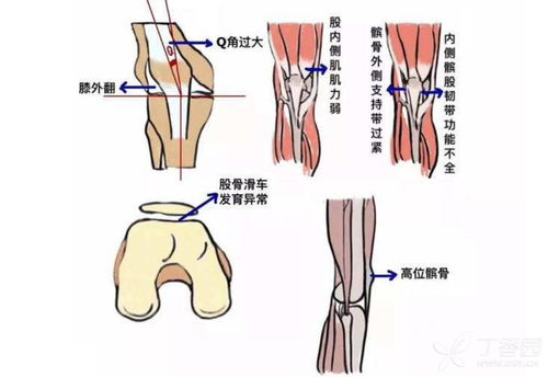 髌骨软化症常见的症状有哪些?