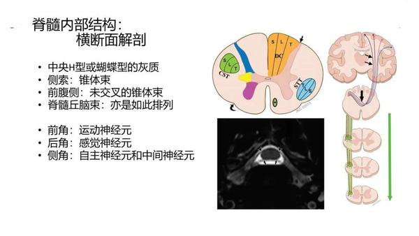 累及前角的病变 急性脊髓灰质炎 婴儿性肌萎缩症 乙型脑脊髓炎 进行