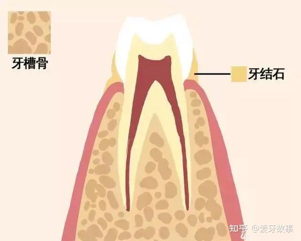 牙龈,牙骨质,牙周膜,牙槽骨都属于牙周组织. ●牙结石