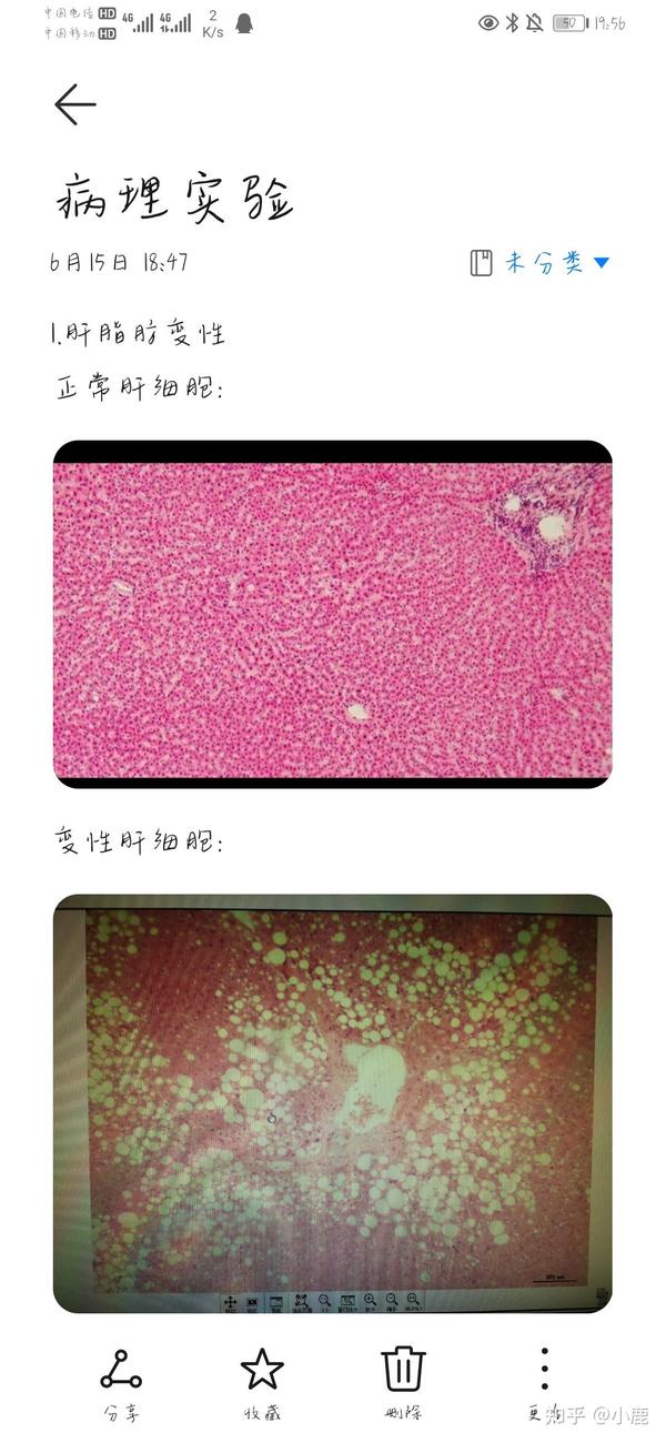 部分病理学切片红蓝铅笔手绘图,画的有一点点丑