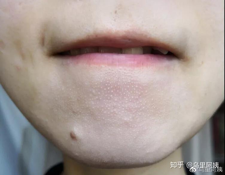 下巴长白色的小颗粒_下巴白色的小颗粒