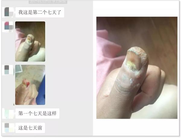 左手大拇指指甲前端90%的皮肤被甲周疣接种传染.传染相对严重.