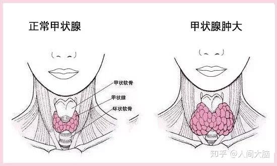 脖子变粗一定是甲亢引起的吗罪魁祸首有可能是它