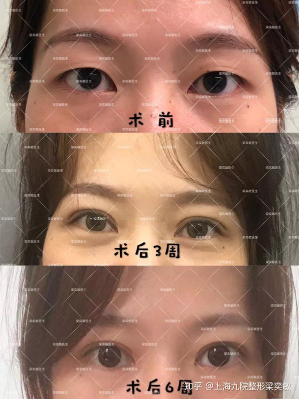 切开法重睑成形术,重现永久性自然双眼皮!
