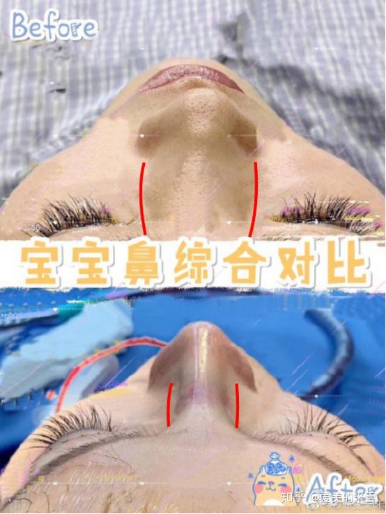鼻子塌怎么办只能隆鼻吗