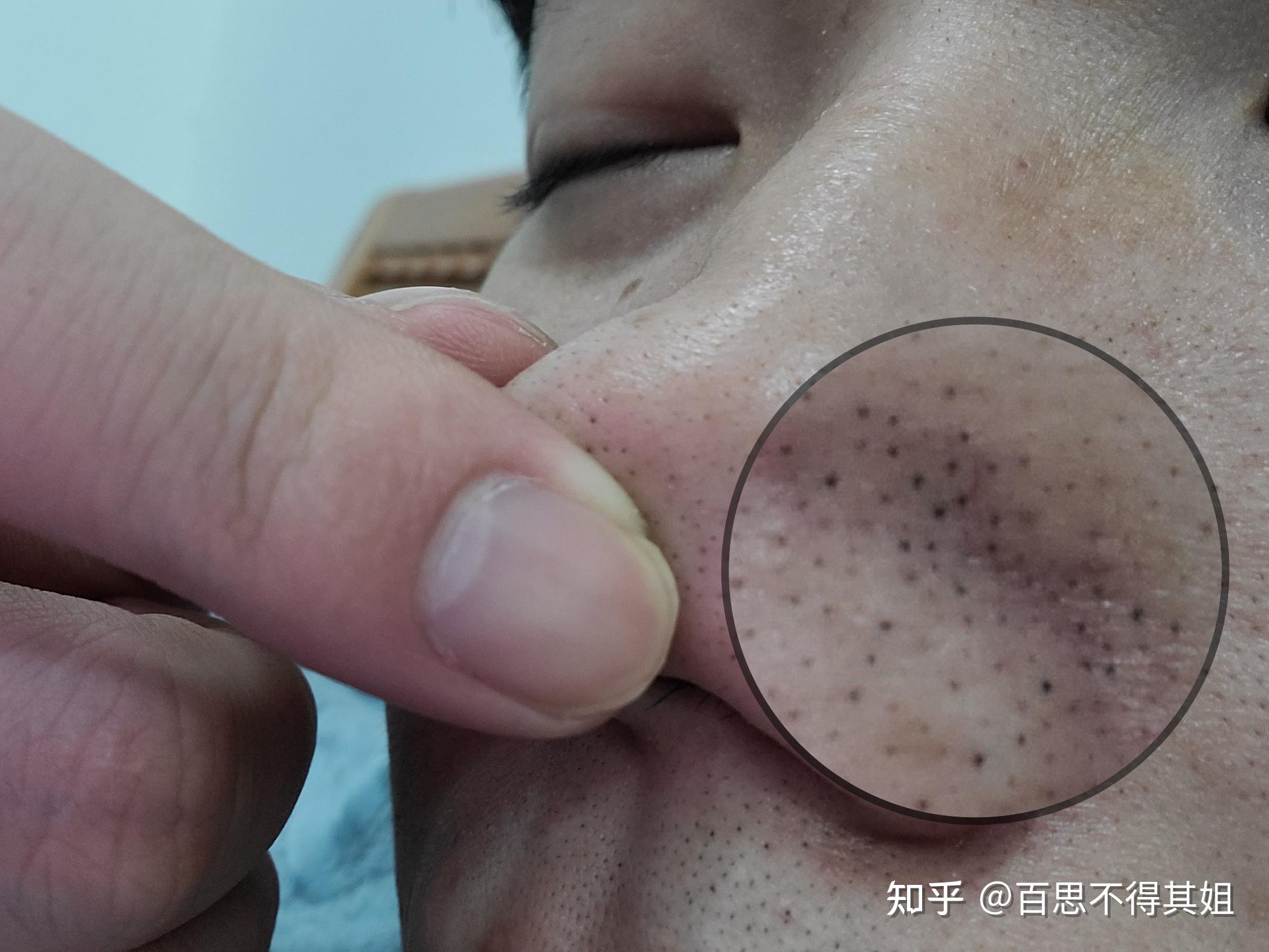 为什么我的黑头用卸妆油搓不出来