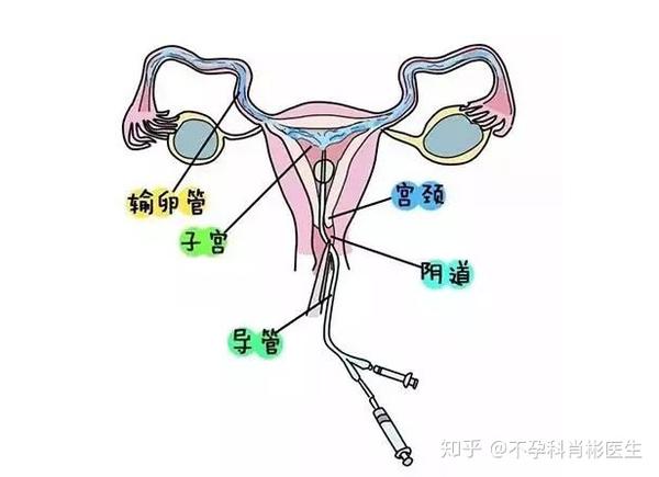 输卵管检查是否每位不孕患者都必须做吗