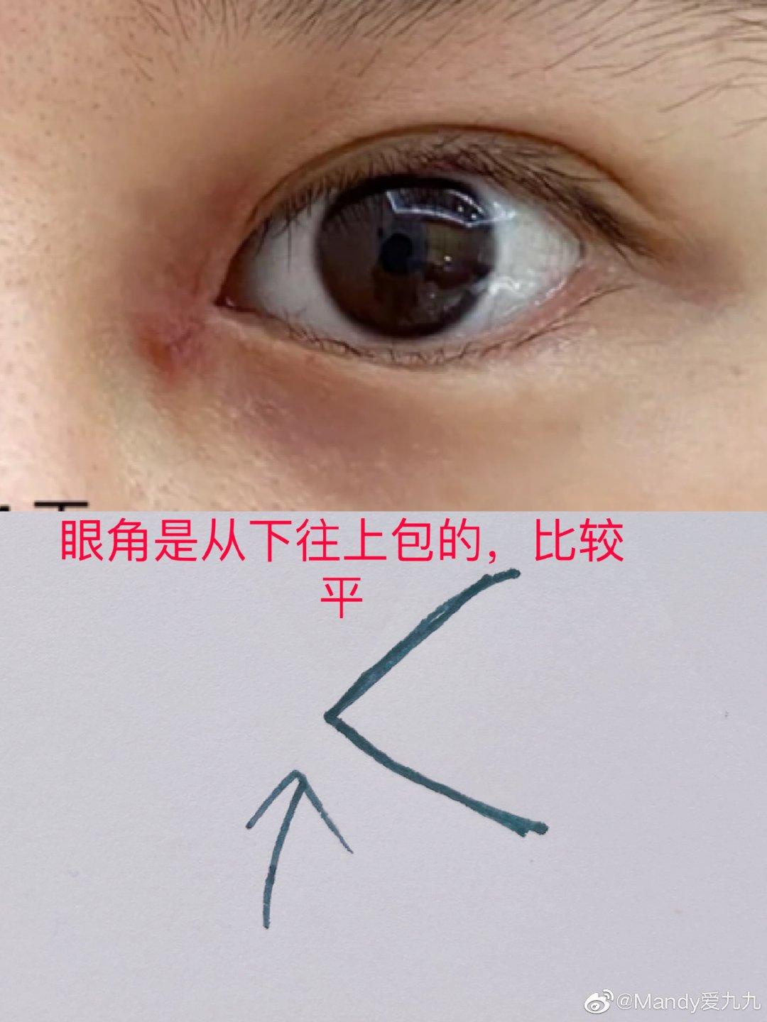 国内主流内眼角修复医生对比合集
