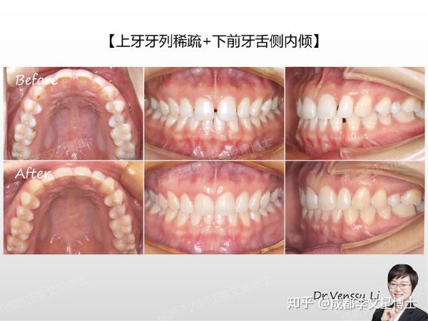 成都隐形矫正:『上牙牙列稀疏 下前牙舌侧内倾』隐适美不拔牙正畸案例