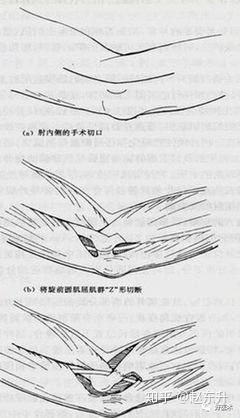 (肘管综合征是怎么回事?