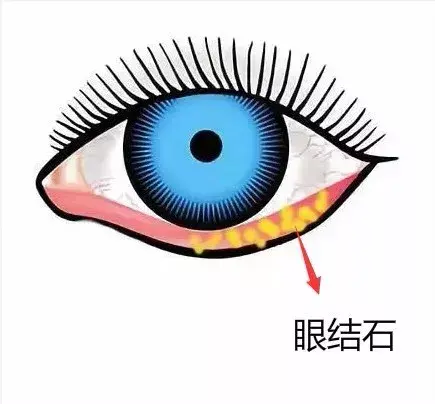 医学上称其为 "眼结膜结石",其实就是结膜脱落的上皮细胞,变性的白