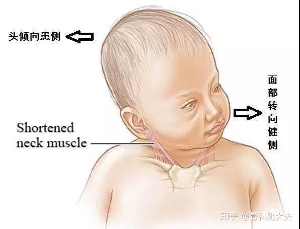 小孩"歪脖子",确诊了先天性肌斜颈要怎么办?