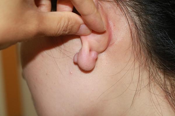 耳朵上长的瘢痕疙瘩,大多都是为臭美付出的代价!